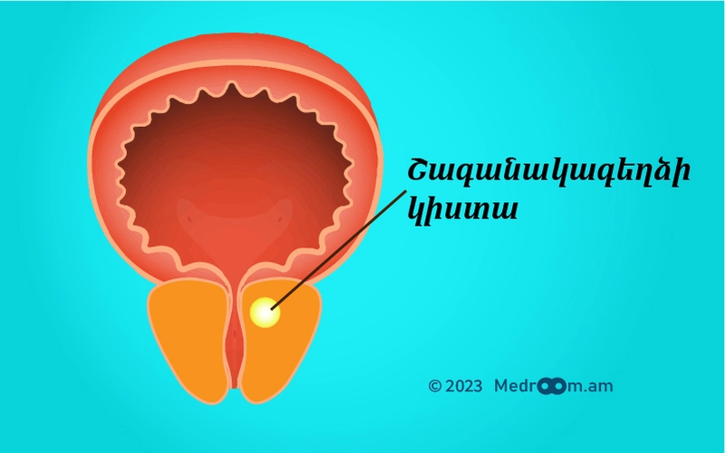 Շագանակագեղձի կիստա
